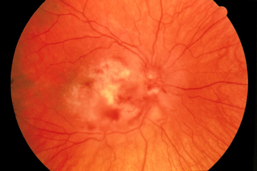 Цитомегаловирусный ретинит при ВИЧ-инфекции.